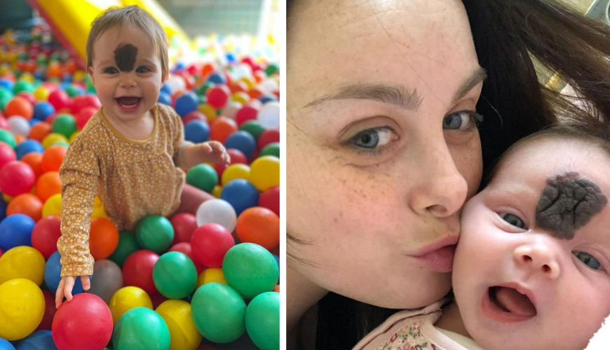 “Parents Help Their Daughter Get Rid of Birthmark Because People Stared at Her”