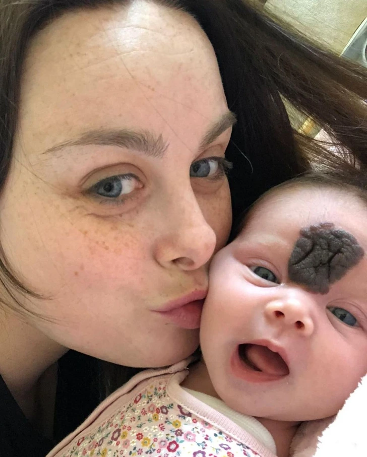 baby with birthmark